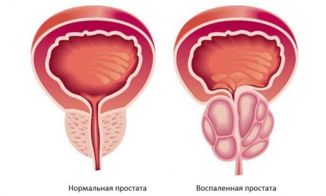 Здоровая и воспалённая простата